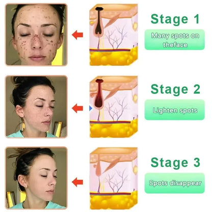 Clareluz® Exfoliante Anti-Acné para Manchas y Piel Lisa